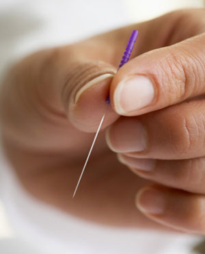 Acupuntura Acupuntura